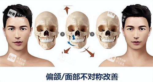 正颌手术原理与对比展示动画图