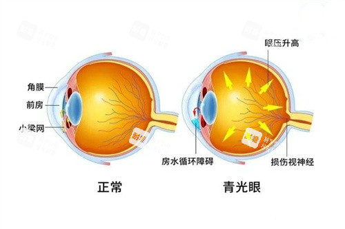 青光眼与正常眼对比图