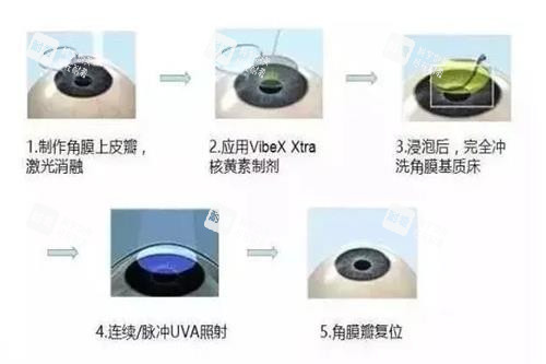 圆锥角膜手术过程