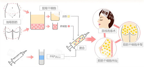 自体脂肪隆胸过程