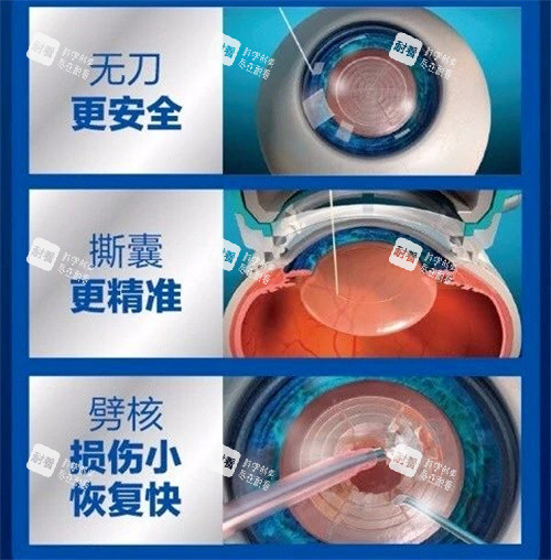 飞秒激光治疗白内障手术图