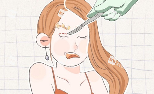 拉双眼皮示意图