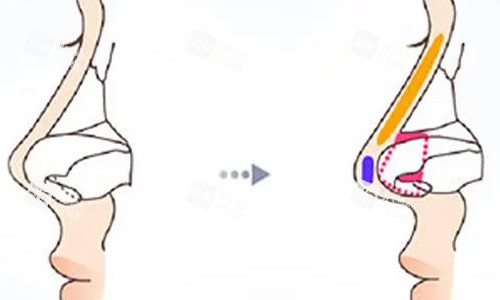 鼻小柱延长的前后对比图