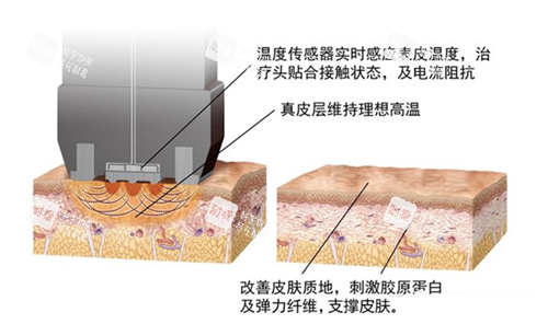 钻石超塑的作用