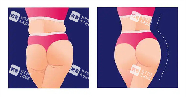 臀部脂肪填充