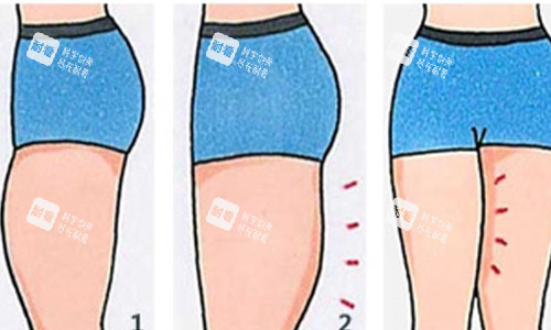吸脂前后对比动画图