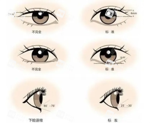 双眼皮对比图
