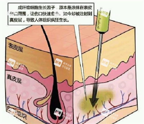 生长因子的副作用解析