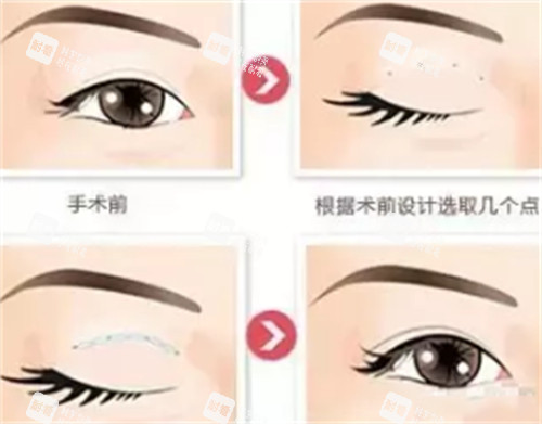贝塞尔双眼皮手术过程图解