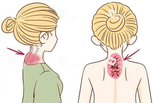 改善富贵包前后对比