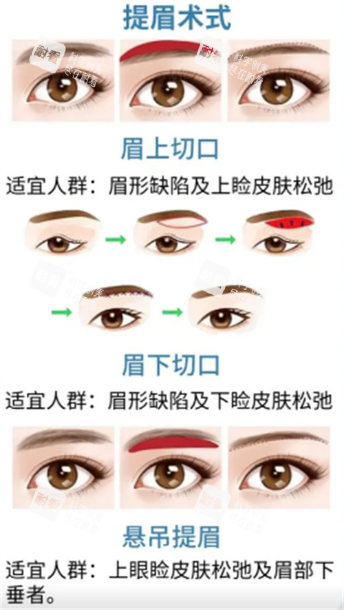 提眉术式解析