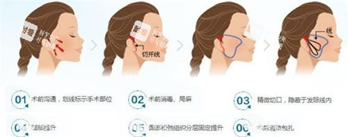 微拉美拉皮手术过程图