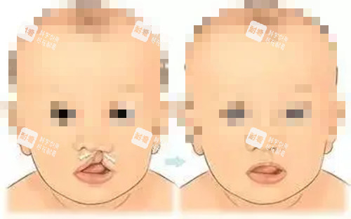 唇腭裂修复前后对比示意图