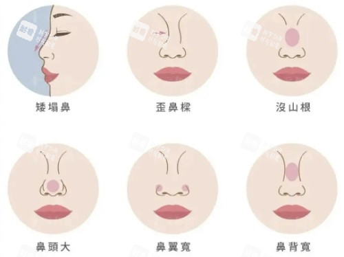 各种问题鼻型示意图