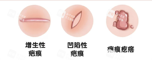 疤痕修复