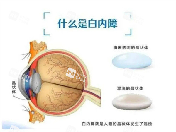 什么是白内障
