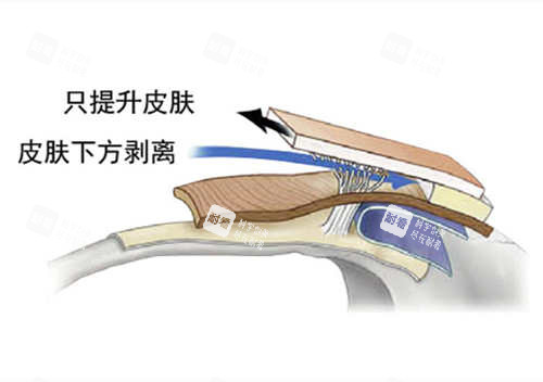 SMAS筋膜层图片