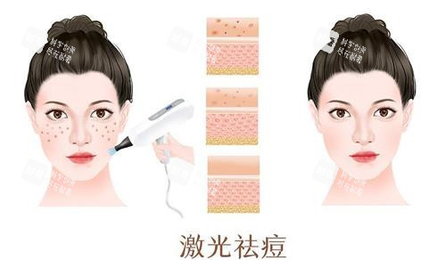 激光祛痘前后的对比