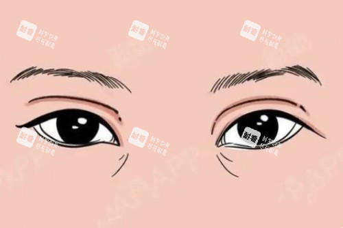 双眼皮失败卡通图