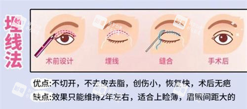 双眼皮手术埋线法动画演示图