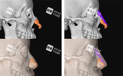 FITme3D鼻假体使用对比展示