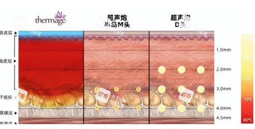 超声炮治疗深度对比