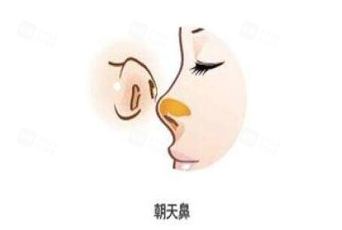 朝天鼻整形手术