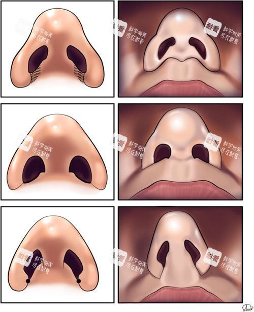 鼻整形的对比