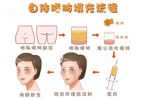 自体脂肪移植填充额头动画演示图