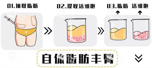 自体脂肪移植过程