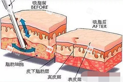 吸脂前后脂肪对比图