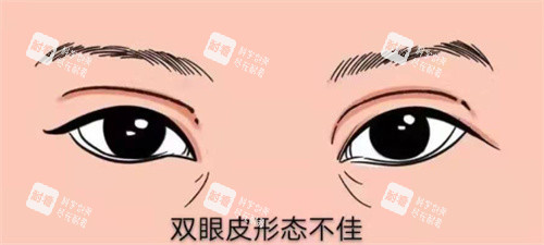 双眼皮修复示图