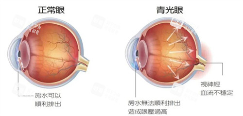 正常眼睛和青光眼的不同之处