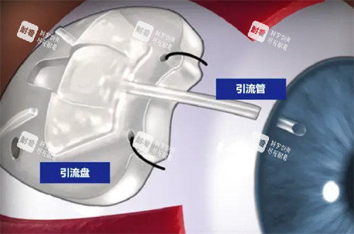 青光眼引流阀