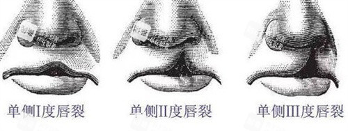单侧唇裂等级
