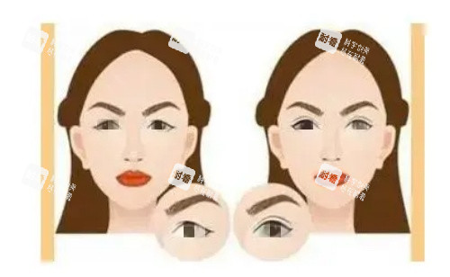 双眼皮术前术后对比图