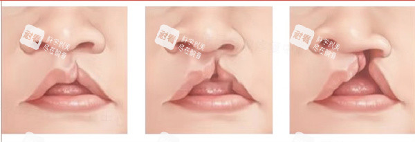 单侧唇裂