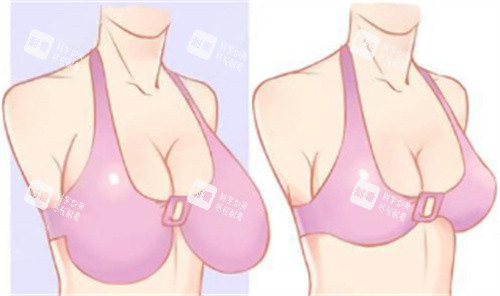 巨乳缩小术
