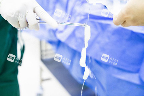 3d生物束带紧缩术实物图