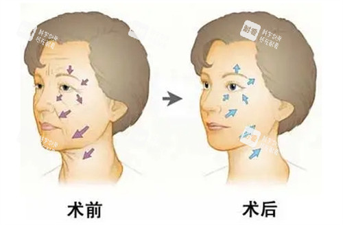 面部年轻化管理前后对比