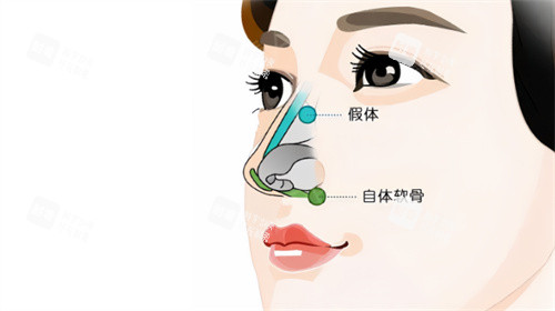隆鼻卡通示图