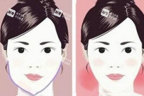 脸型不对称矫正前后对比图