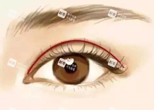 新月形双眼皮
