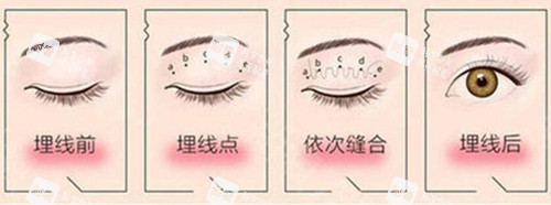 埋线双眼皮过程示意图片