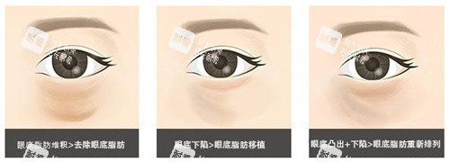 眼底脂肪重排对比