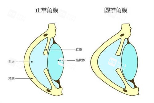 圆锥角膜和正常角膜的对比