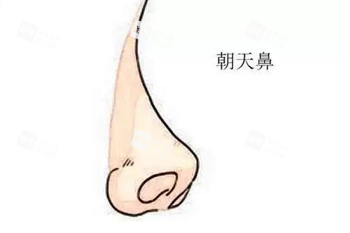 朝天鼻改善卡通图展示