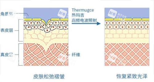 热玛吉作用在皮肤上皮下组织展示