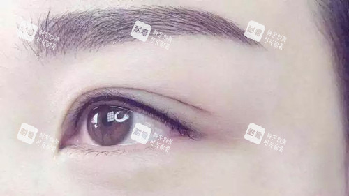 双眼皮实拍