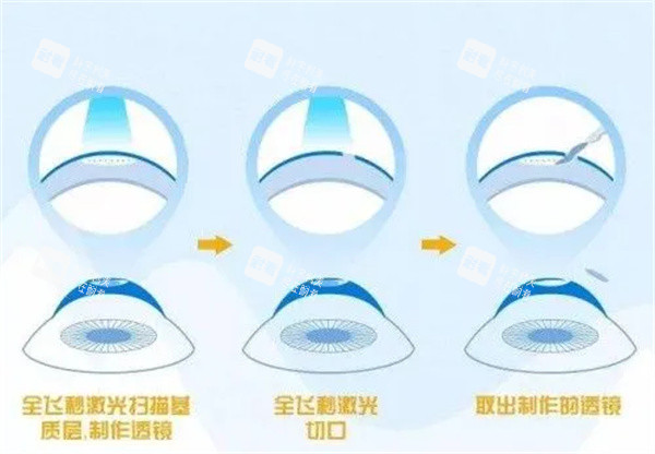 全飞秒激光眼睛照片